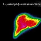 Радиоизотопное сканирование печени