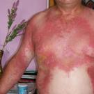 What is dangerous and how to treat a hogweed burn?